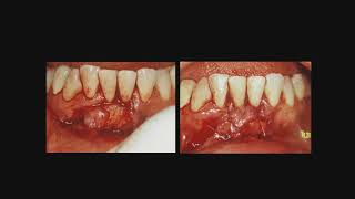 Lecture 18 – Surgical Management of the Mandibular Frenum [upl. by Ylahtan820]