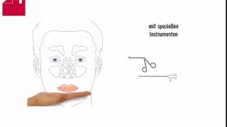 Nasen OP  Nasenscheidewand OP  Septumplastik [upl. by Atnas]