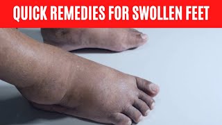 Home Remedies for Swollen Feet  Edema Remedy [upl. by Dunton]