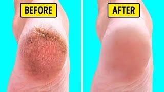 10 Natural Home Remedies for Silky Smooth Feet [upl. by Hedvige783]