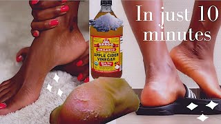 how to remove dead skin from your feet naturally at home 2021 cracked heels home remedy [upl. by Eimaral]