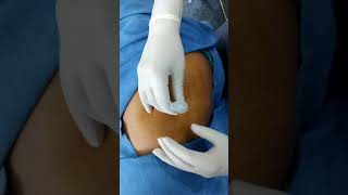 Trochanteric Bursitis Injection Depomedrol [upl. by Romain]