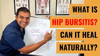 What Is Hip Bursitis Symptoms amp Diagnosis [upl. by Wallack93]