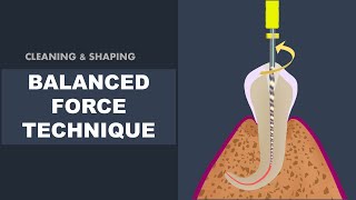 Balanced Force Technique  Cleaning and Shaping [upl. by Lloyd]