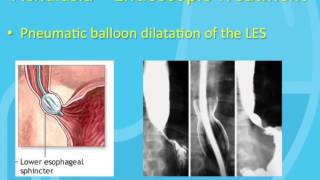 Treatment of Achalasia [upl. by Airetnahs113]