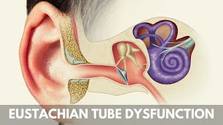 What is Eustachian Tube Dysfunction [upl. by Daveda947]