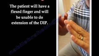 Mallet Finger  Everything You Need To Know  Dr Nabil Ebraheim [upl. by Aubrey]