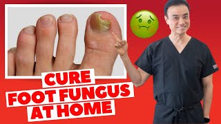 6 Effective HOME REMEDIES To CURE Toenail FUNGUS  Holistic Toenail Fungus Cures Part 2  Dr Kim [upl. by Petit252]