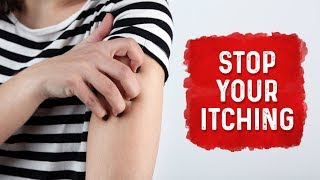 What Causes Hives and Itchiness  Urticaria Hives Treatment  Dr Berg [upl. by Breh]