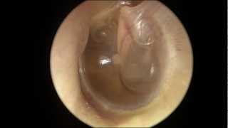 Serous Otitis Media [upl. by Eelatan]