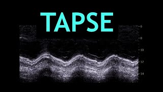 All about TAPSE Echocardiography [upl. by Ahseined862]