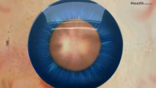 Cataract Surgery how it is performed [upl. by Halden]