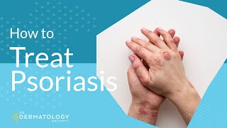 Psoriasis Treatment  Explained by Dermatologist [upl. by Aeneas]