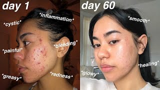 I CLEARED MY ACNE 60 days using Differin Gel Adapalene 01  pictures [upl. by Aiello957]