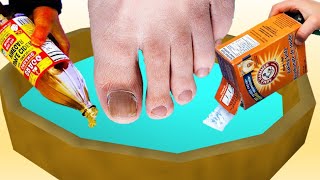 How to Get Rid of Nail Foot Fungus Permanently Using 2 home Ingredients [upl. by Narah872]