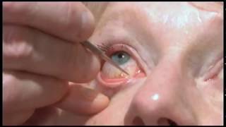 Oculoplastics basic exam Lacrimal system examination [upl. by Shetrit226]