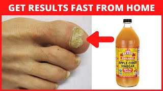 Apple Cider Vinegar for Toenail Fungus [upl. by Appilihp]