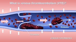 Understanding and Diagnosing Venous Thromboembolism VTE [upl. by Eniruam]