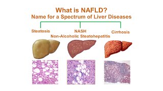 Will a Liver Cleanse Help Cirrhosis and a Fatty Liver – DrBerg [upl. by Dorsy424]