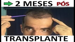 2 Meses Pós Implante Transplante CAPILAR  Resultado 60 dias Antes e Depois implante capilar [upl. by Vacuva302]