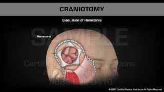 Craniotomy [upl. by Acnairb]