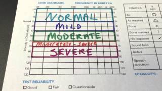 How to Read Your Audiogram [upl. by Fanchette259]