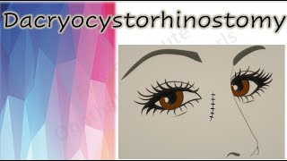 Dacryocystorhinostomy  DCR [upl. by Myranda]