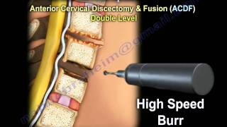 Cervical Spine Decompression And Fusion   Everything You Need To Know  Dr Nabil Ebraheim [upl. by Zoi]