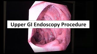 Upper GI Endoscopy Procedure in the ED [upl. by Elokyn]