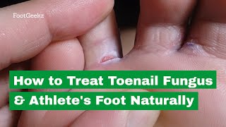 How to Treat Toenail Fungus amp Athletes Foot Naturally [upl. by Drallim]