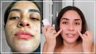 PRIMER MES CON TRATAMIENTO ANTI ACNÉ Con Epiduo Gel  Gabcamva [upl. by Rustie286]