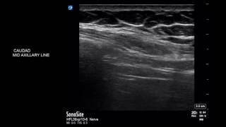 Diaphragmatic scanning using USG  ABCDE technique [upl. by Magavern]