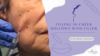 Filling in Cheek Hollow With Fillers [upl. by Rosabella]