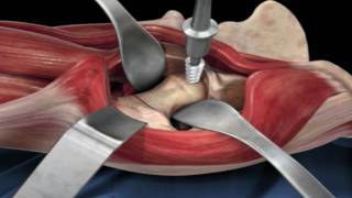 Direct Anterior Approach Hip Replacement [upl. by Lanrev385]