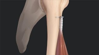 Biceps Tenotomy vs Tenodesis Literature Review and Rationale for Tenodesis [upl. by Hawley260]