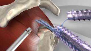 Knotless Rotator Cuff Repair with Arthrex® SpeedFix™ [upl. by Paxon164]